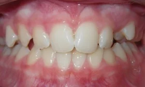 Before braces — crowded teeth, Brooklyn patient