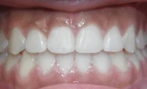After — Invisalign result in Brooklyn