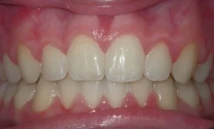 After — teen with straightened teeth