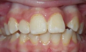 Before — pre-treatment intraoral view