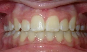 After — braces removed, final smile