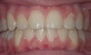 After — well-aligned smile after braces
