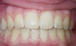 After braces — straightened smile result