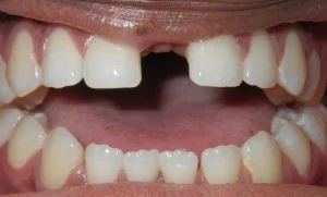 Before braces — alignment issue