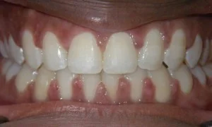 After braces — corrected bite result