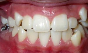 Adult orthodontic patient before treatment