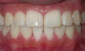 Adult orthodontic patient after treatment