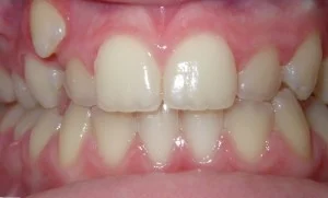 Before — ceramic braces case start