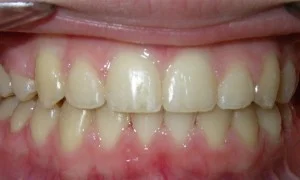 After — open bite treatment result