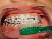 Brushing step 1