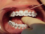 Flossing step 1