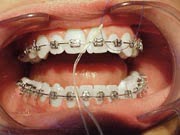 Flossing step 2