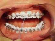 Flossing step 3