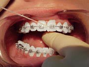 Flossing step 4
