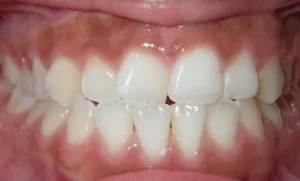 Crossbite fixed with braces