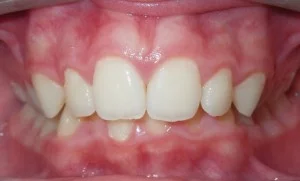 Jaw alignment before and after