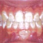 Brushing results: clean vs. plaque buildup