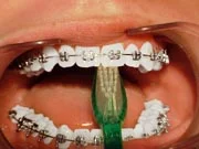 Brushing and Flossing with braces