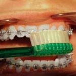 Orthodontic Brushing and Flossing