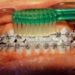 Brushing teeth with braces