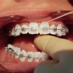 Flossing under orthodontic wire