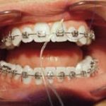 Proper brushing technique for braces