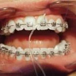 Proper brushing technique for braces