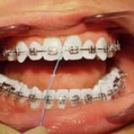 Brushing above and below brackets