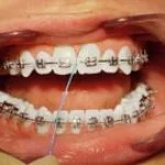 Brushing above and below brackets
