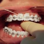 Close-up of flossing around gumline