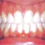 Cleaning teeth with braces step-by-step