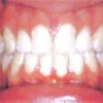 Cleaning teeth with braces step-by-step