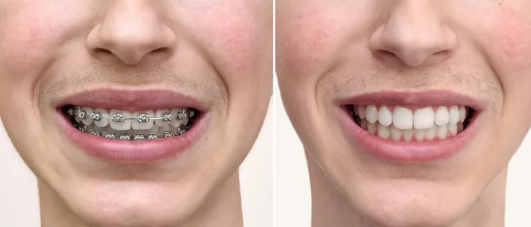 Can Braces Fix an Overbite