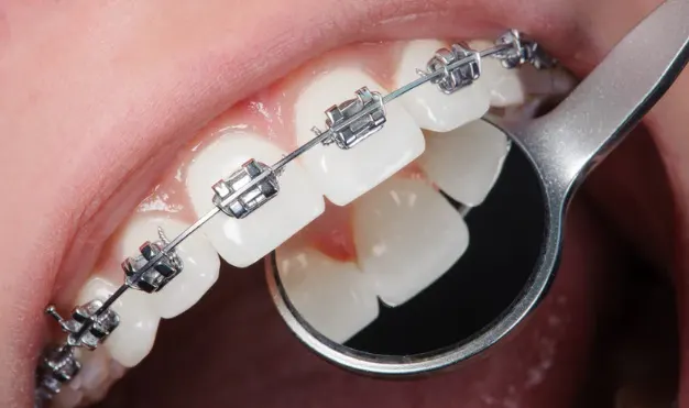 How Much Do Braces Cost in Brooklyn?