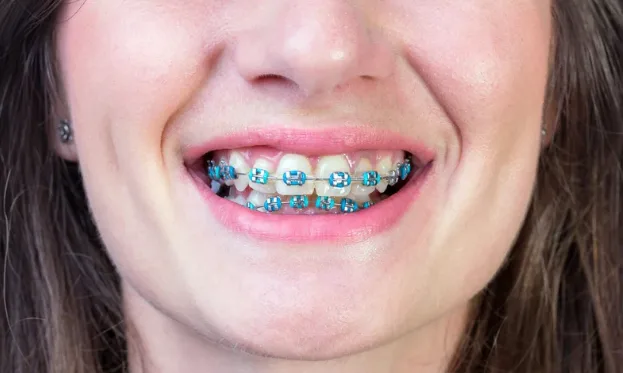 What Are the Best Braces Colors to Choose