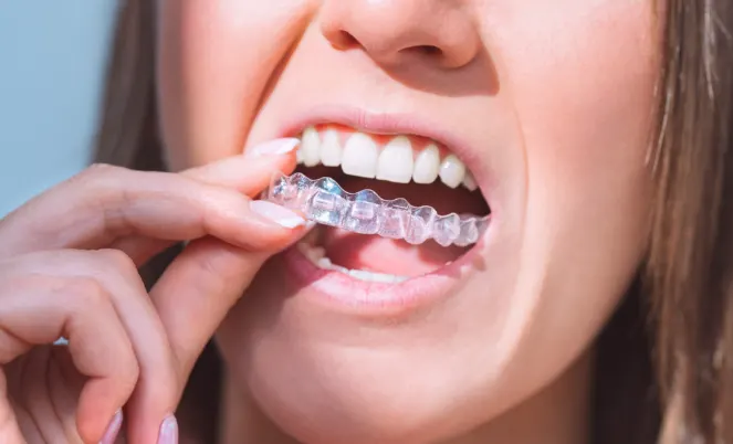 How Much is Invisalign Without Insurance?