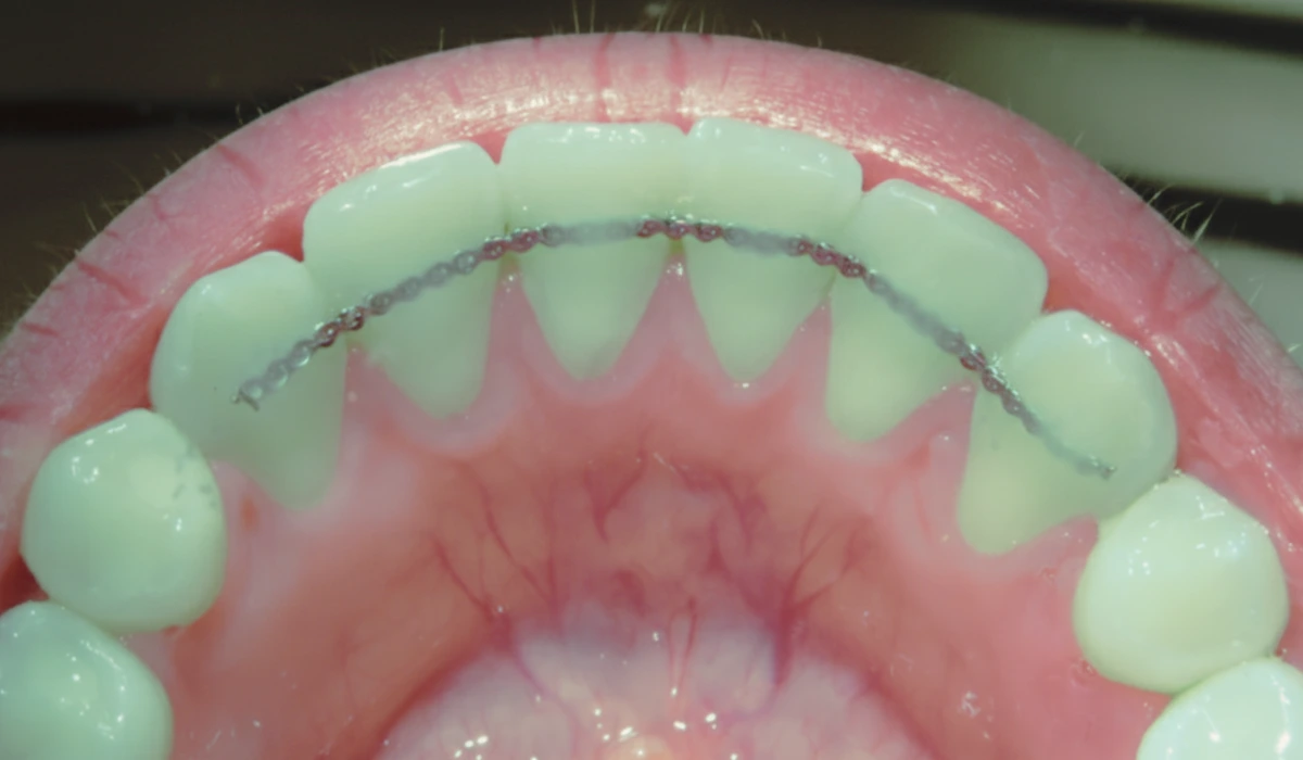 Interior view of a patient's mouth showing a fixed permanent retainer successfully holding teeth in place after braces.